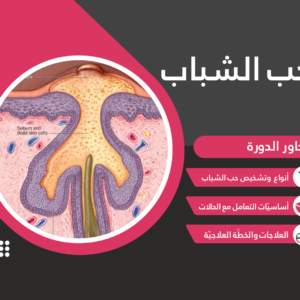 حب الشباب