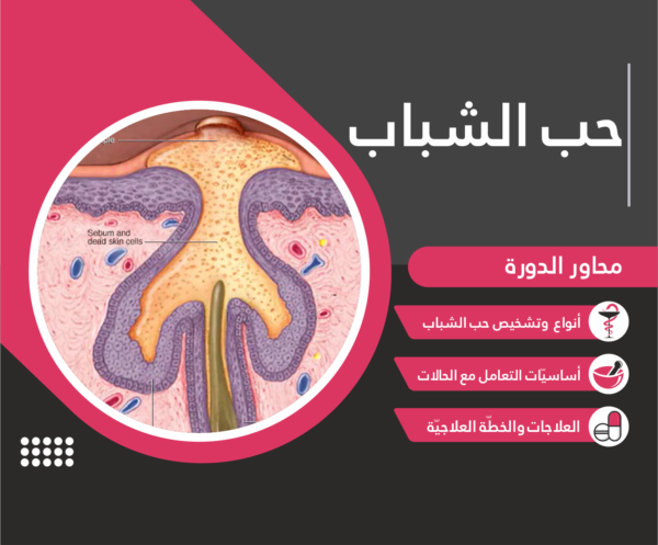 حب الشباب